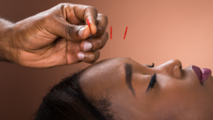 Acupuncture near me